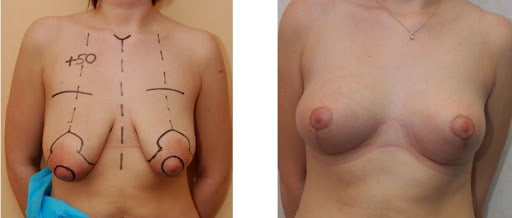 Before and after photo of breast augmentation
