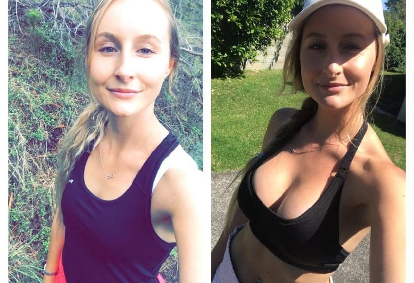 Before and after photos of breast augmentation
