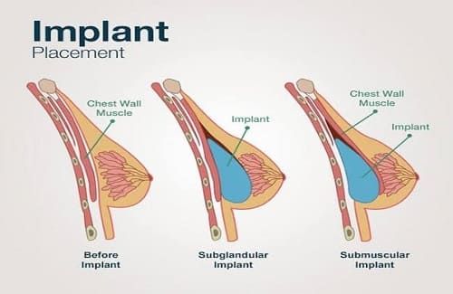 Diagram of implantation of breast implants under and over the muscle