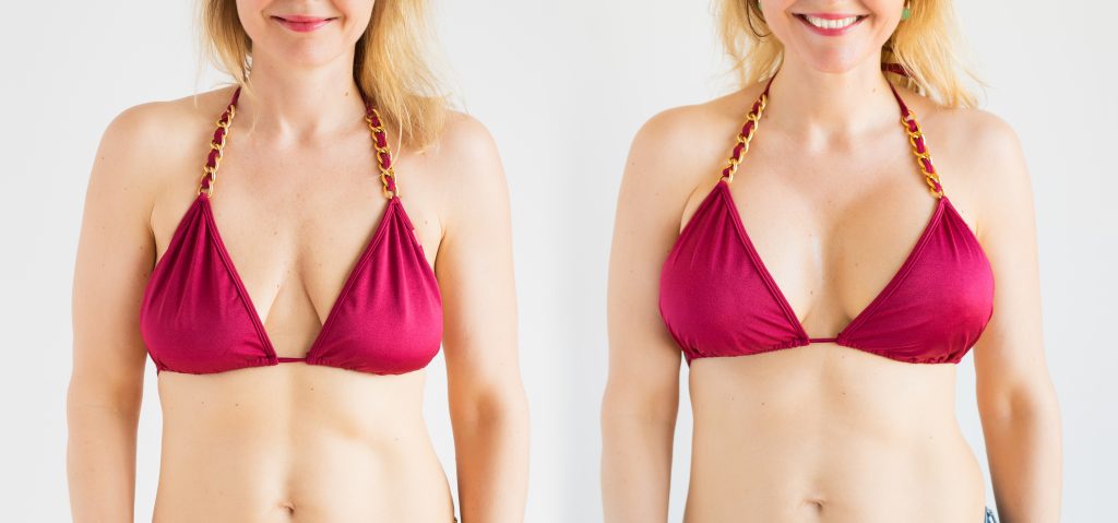Before and after results of breast augmentation