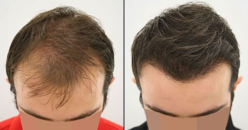 Hair transplant before and after photo