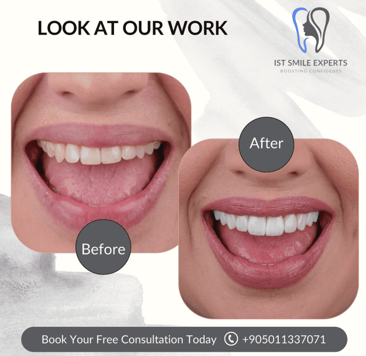 Before and after photos IST Smile Experts
