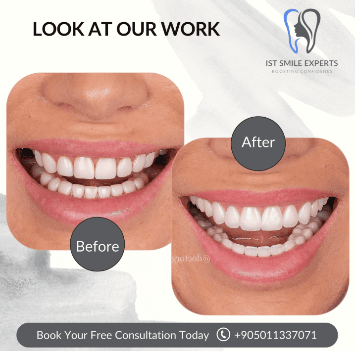 Before and after photos IST Smile Experts