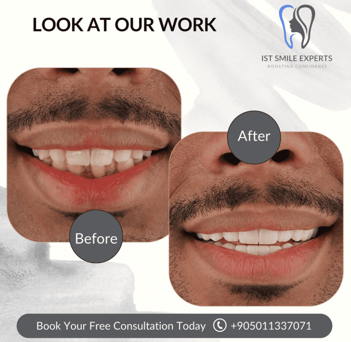 Before and after photos IST Smile Experts