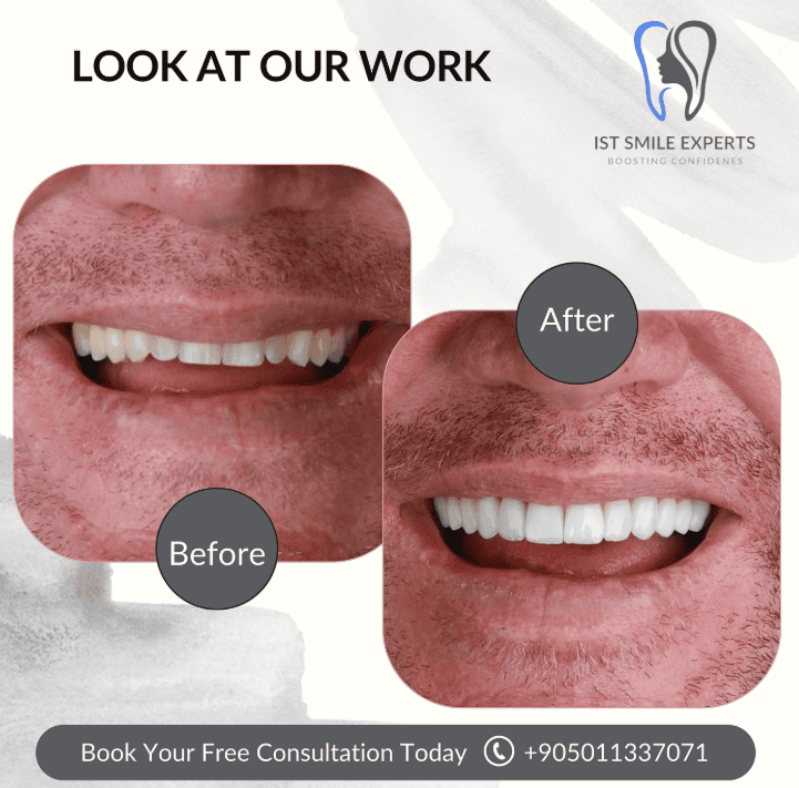 Before and after photos IST Smile Experts