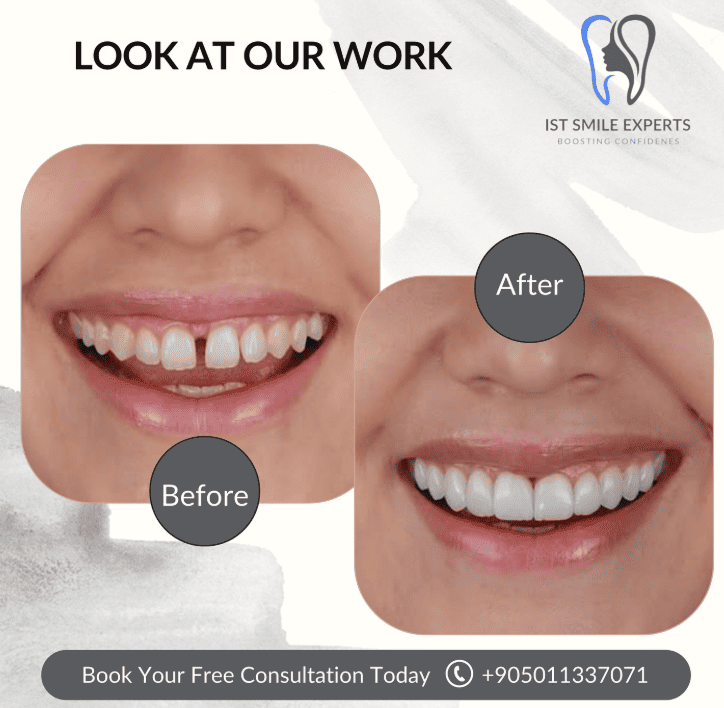 Before and after photos IST Smile Experts
