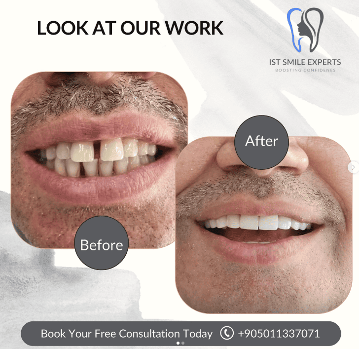 Before and after photos IST Smile Experts