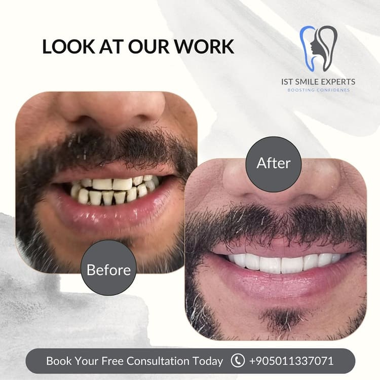 Before and after photos IST Smile Experts
