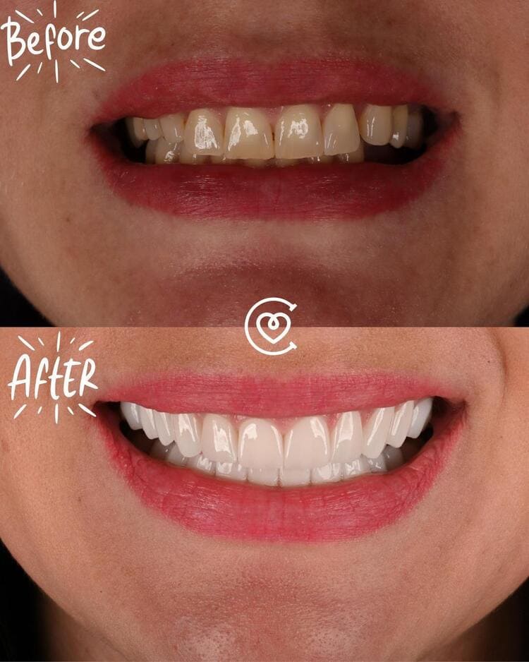 photo before after Cayra Clinic Antalya Istanbul